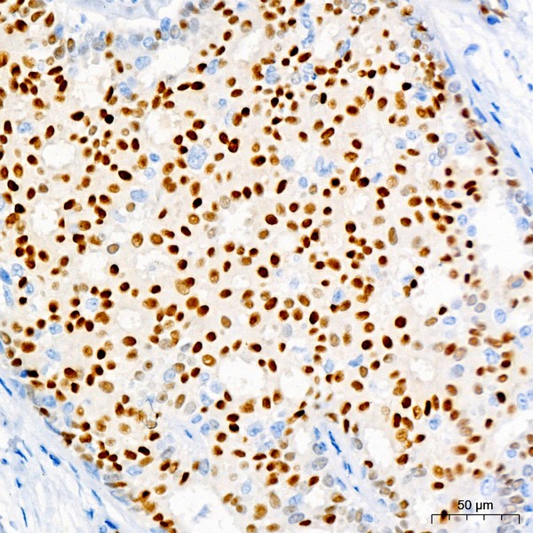 Progesterone Receptor Rabbit mAb (Catalog Number: A19697) Abclonal